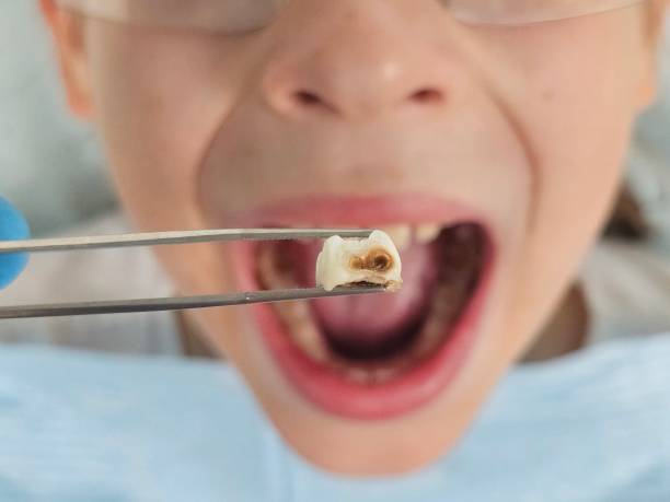 Best Emergency Tooth Extraction in Jackson, MS